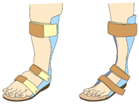 装具のチェックポイント